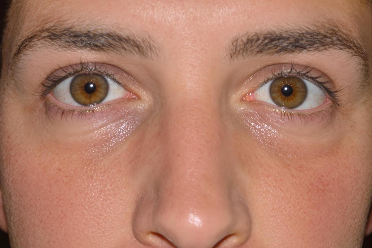 Comprendre les poches sous les yeux