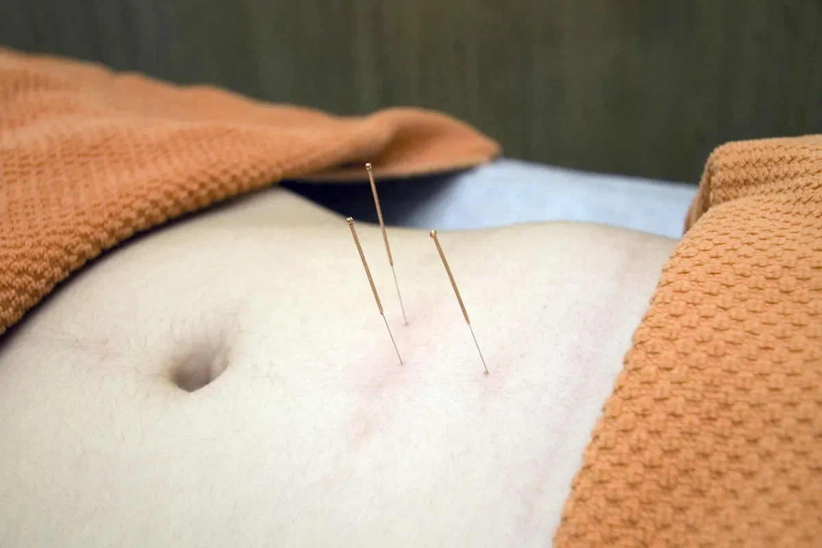 accupuncture